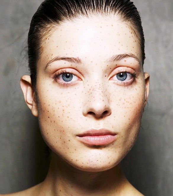 fakides freckles model
