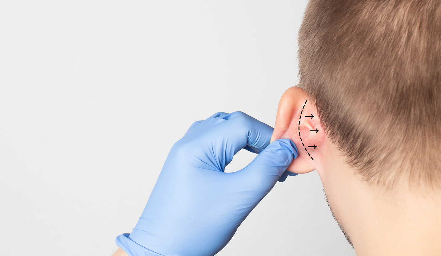 Φωτογραφία ενός αγοριού που θα κάνει ωτοπλαστική. Το χέρι του γιατρού κρατά το αυτί.