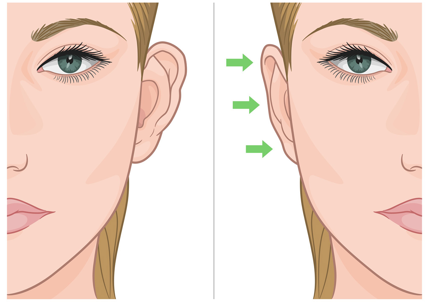 Σκίτσα γυναίκας στο ένα το αυτί πετάει και στο άλλο είναι σωστό. Μετά από χειρουργείο ωτοπλαστικής.