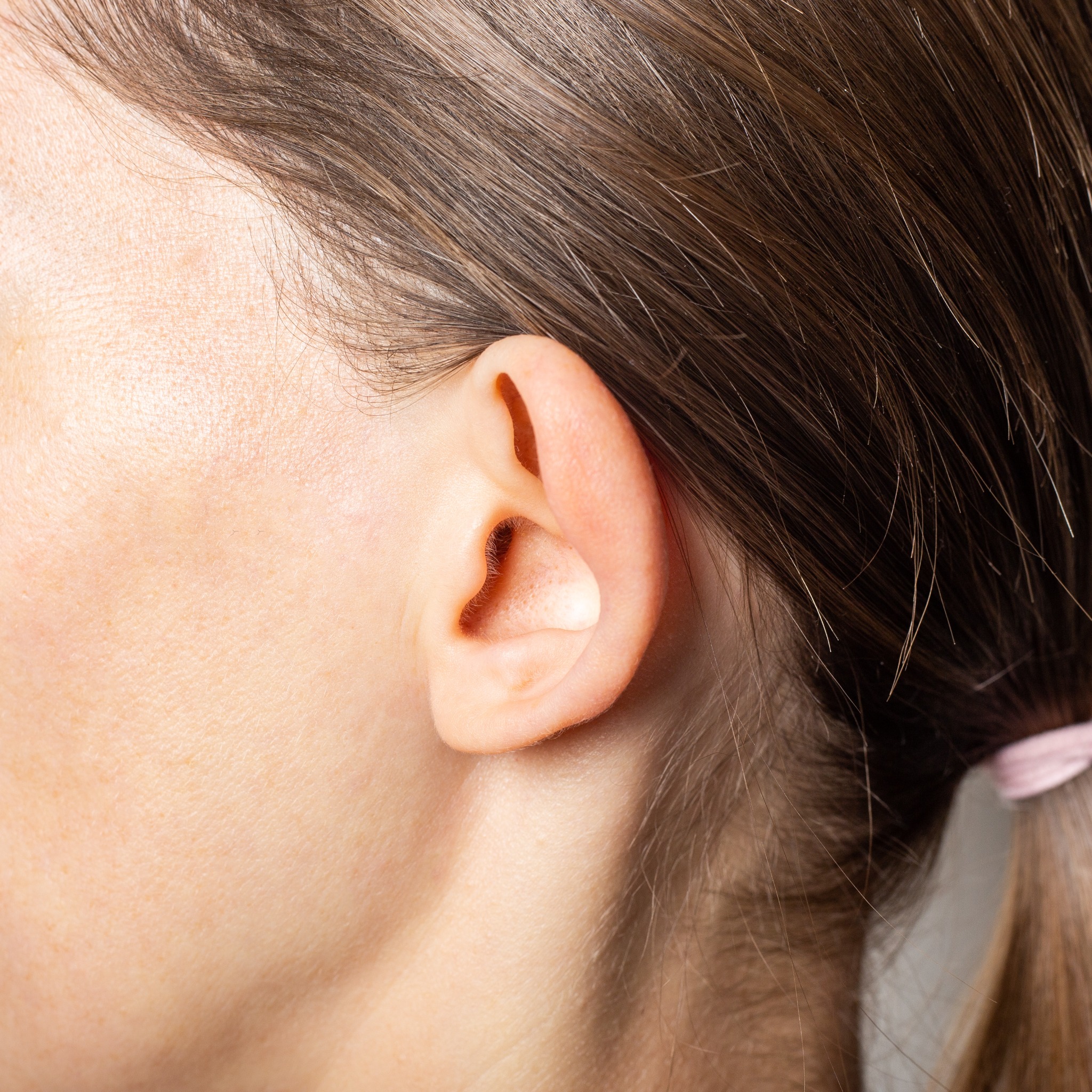 Κοντινό σε αυτί πριν την ωτοπλαστική.