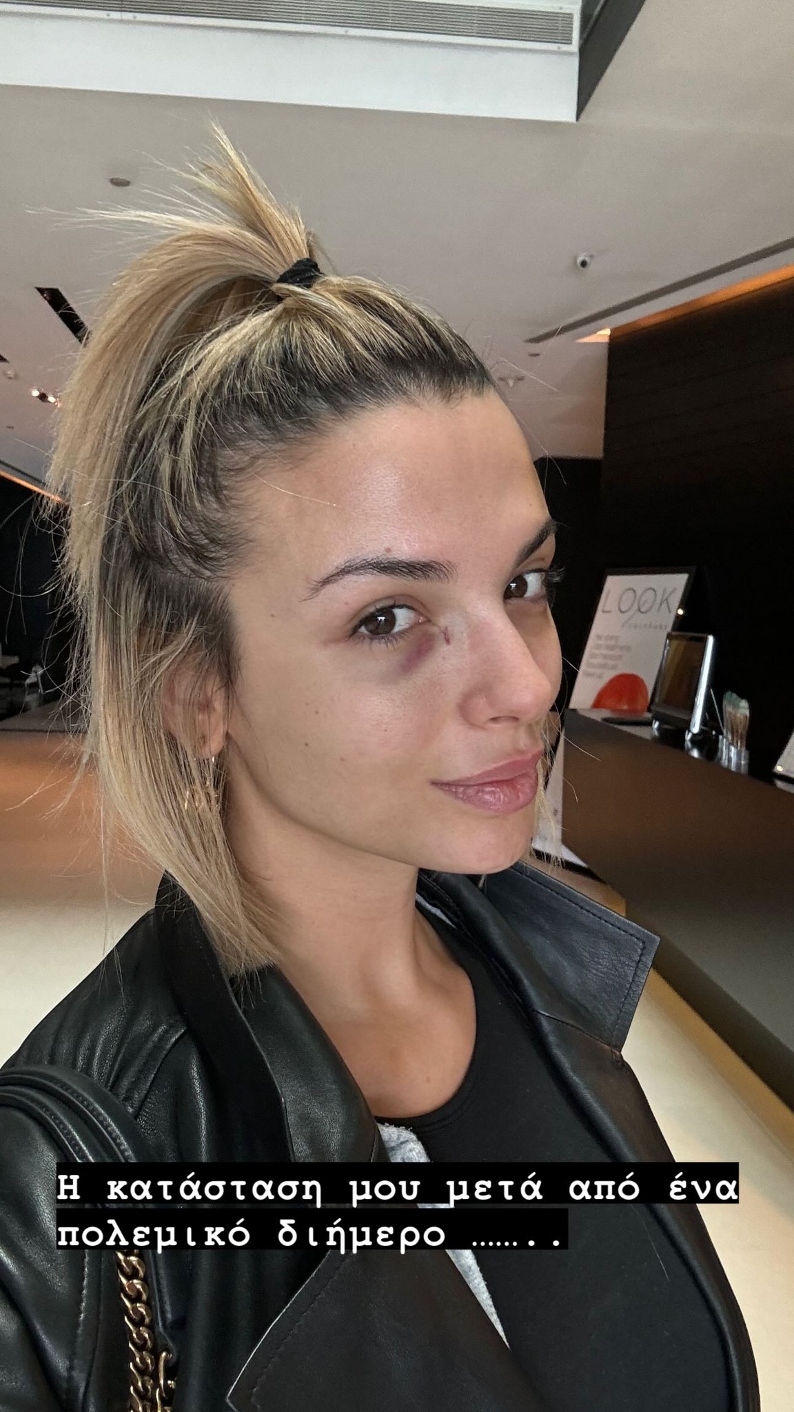 Η Κατερίνα Λιόλιου με μαυρισμένο μάτι