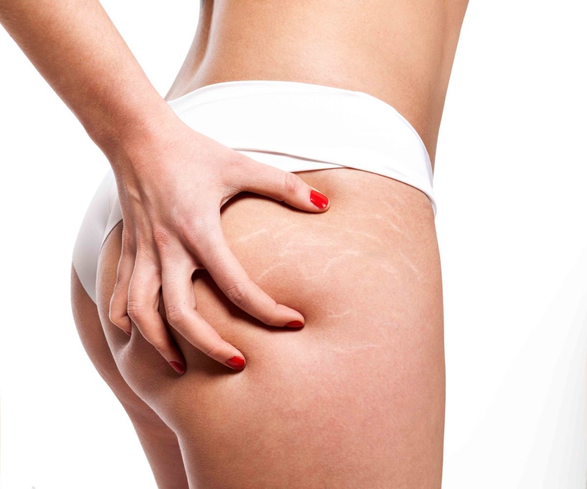 Γυναίκα πιάνει τον πισινό της που έχει ραγάδες