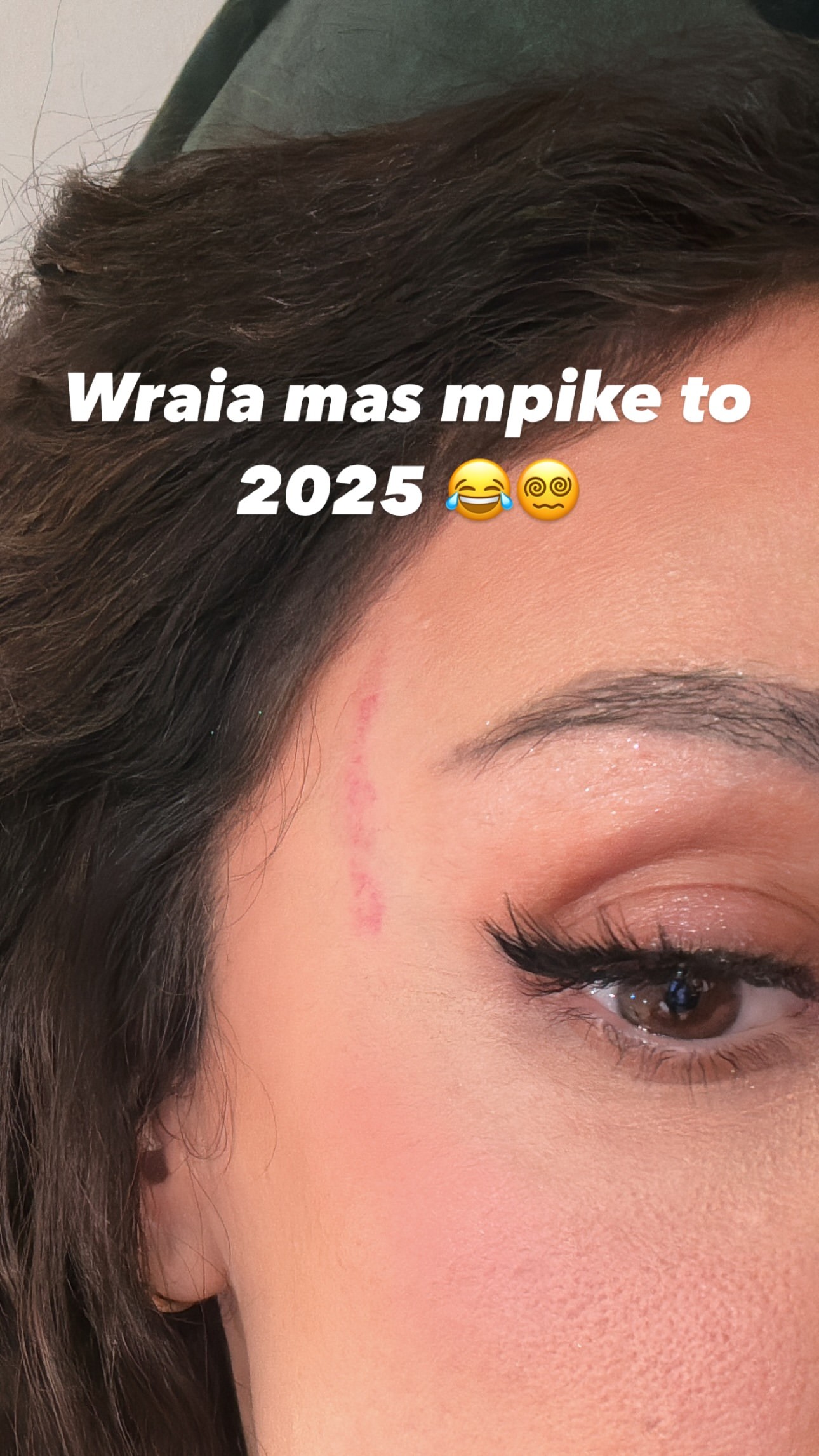 Το σημάδι της Ελένης Φουρέιρα μετά το ατύχημα