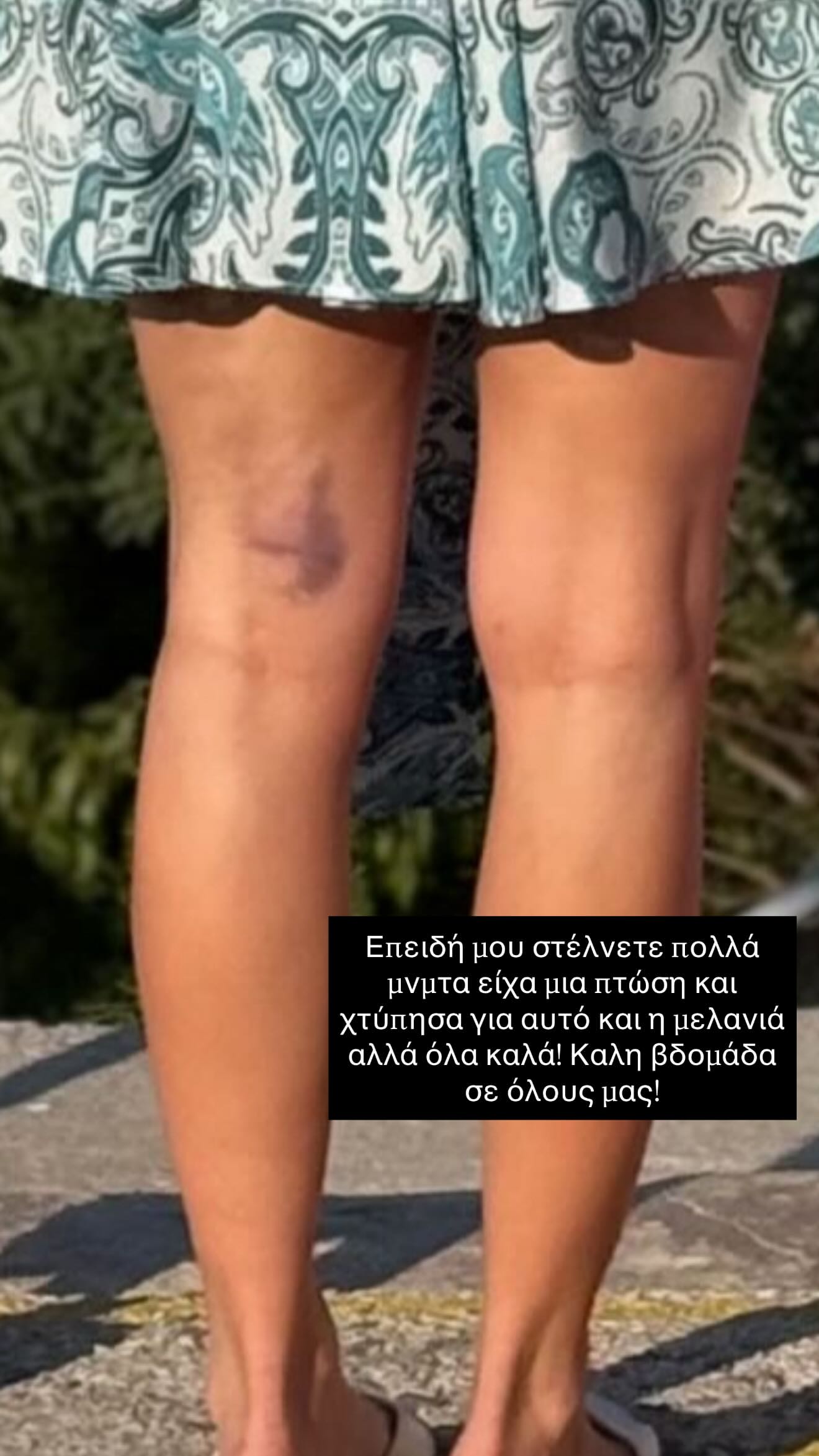 Η μελανιά στο πόδι της Χριστίνας Μπόμπα