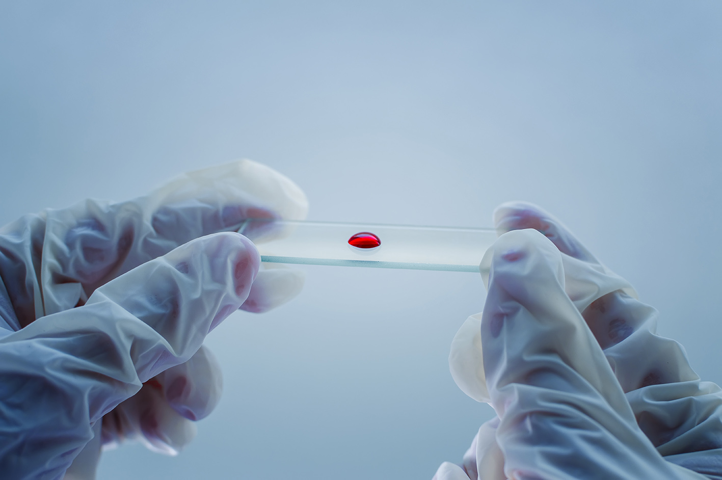 Εξέταση αίματος ακόμη για το Αλτσχάιμερ