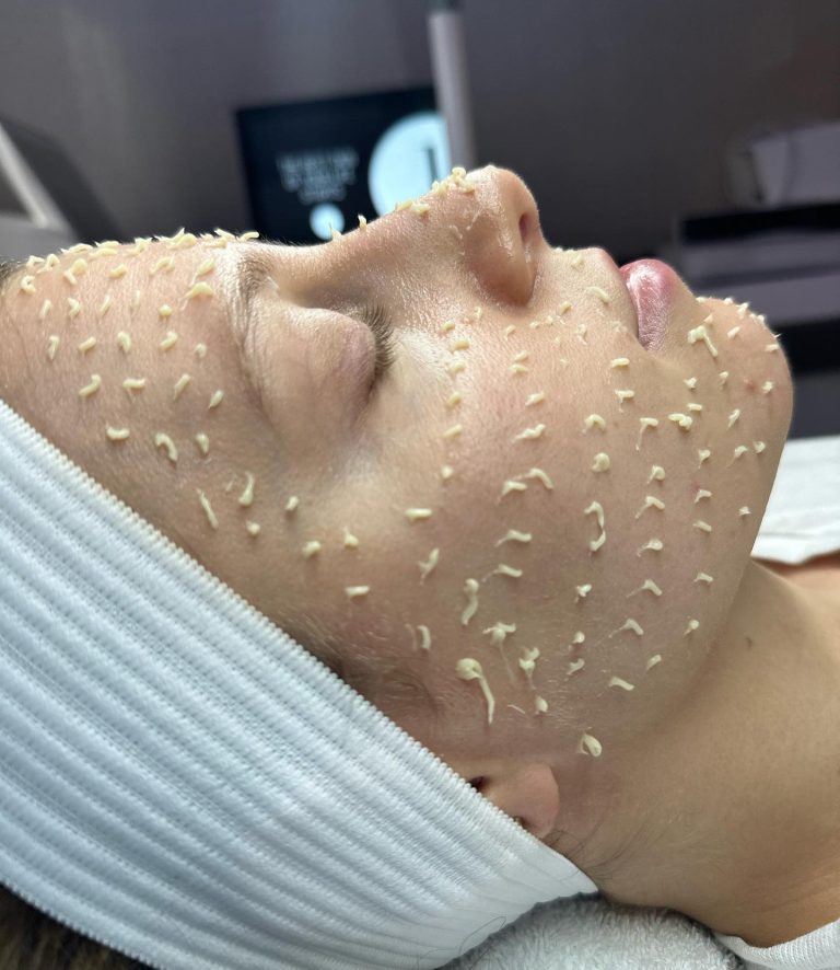 Liquid microneedling