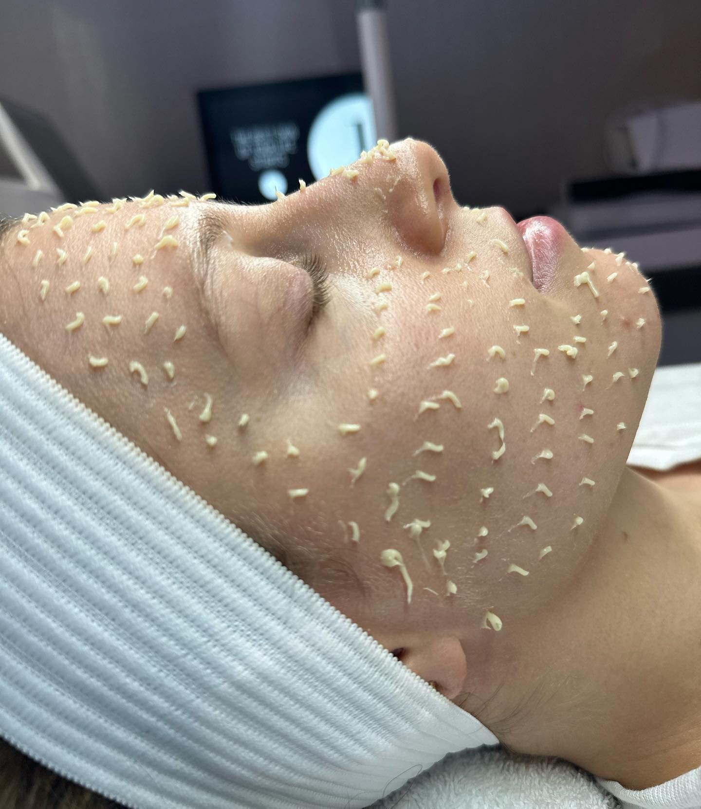 Liquid microneedling