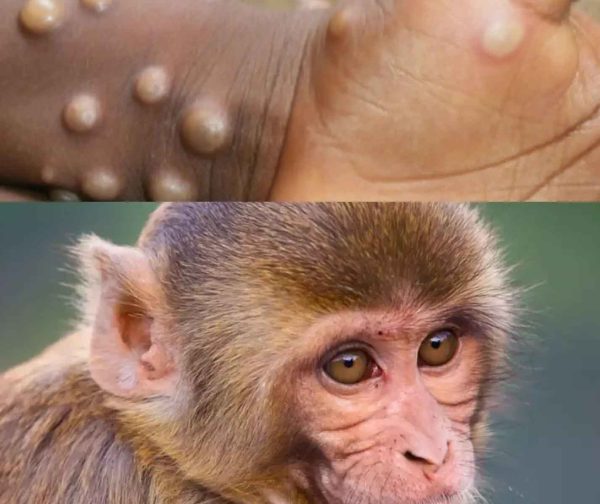 monkeypox-1